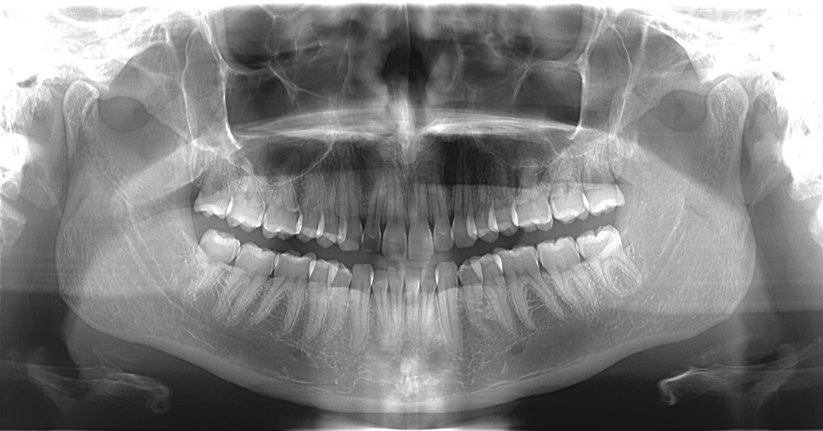 tomographie volumique dentaire